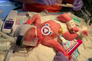 St. Louis fetal care center is one of few in the region to offer surgery for some patients with Spina Bifida